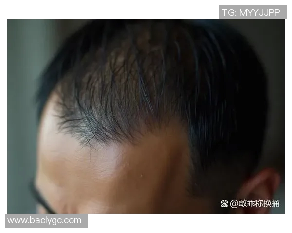 足球明星脱发现象揭秘你知道哪些球星也在为脱发烦恼吗 足球明星脱发现象揭秘你知道哪些球星也在为脱发烦恼吗